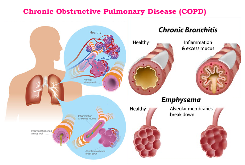 COPD