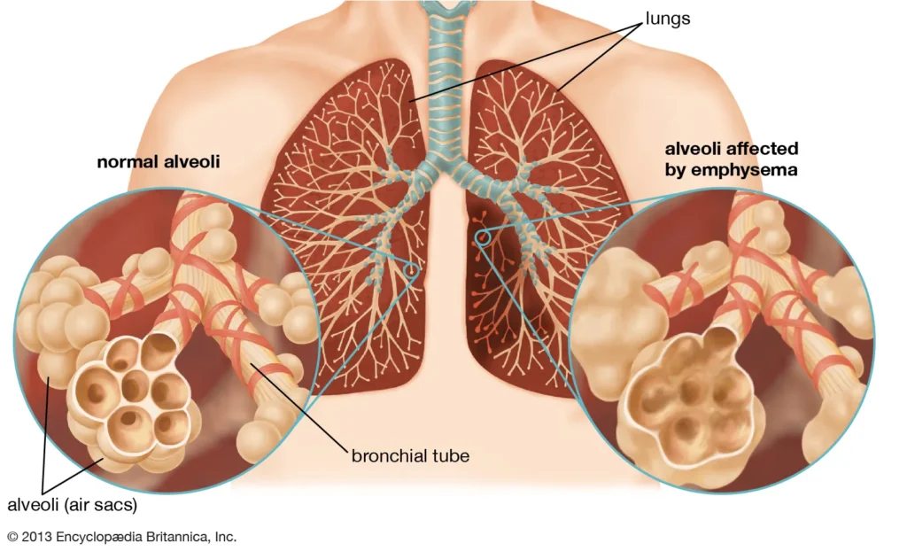 Chronic Obstructive Pulmonary Disease (COPD)