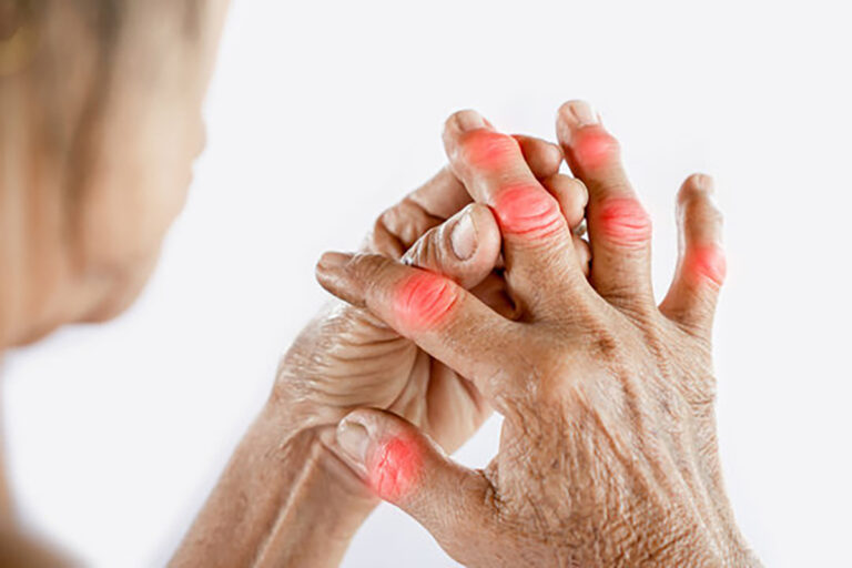 Navigating the Financial Challenges of Arthritis