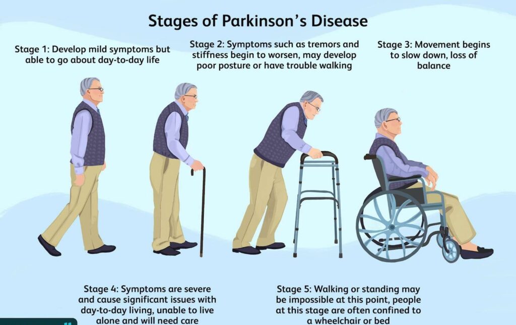 Stages of Parkinson’s Disease