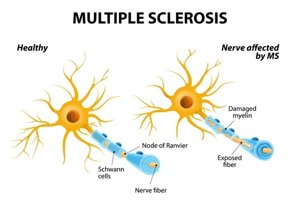 Types of MS