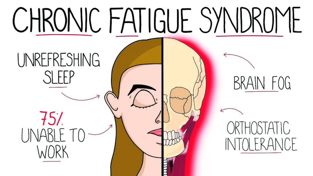 Chronic Fatigue Syndrome