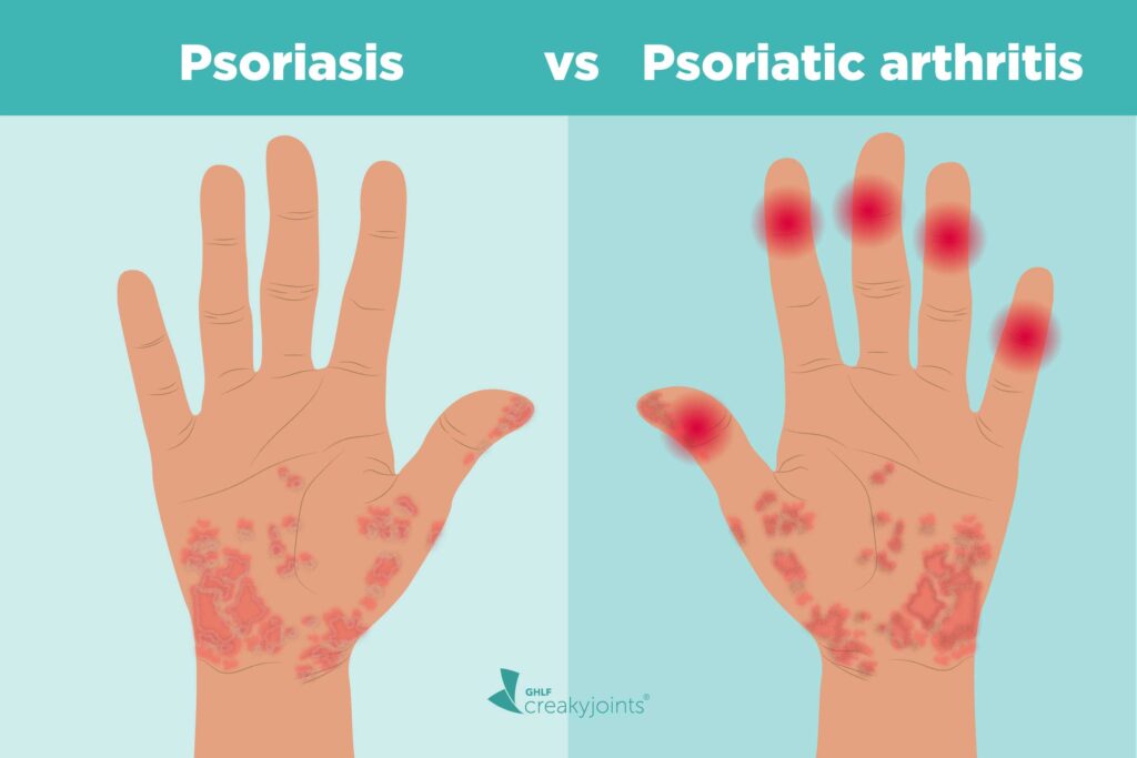 Psoriasis and Psoriatic Arthritis